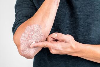 Kremą tepkite ant psoriazės pažeistos odos vietos
