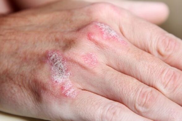 Psoriazės simptomai ant rankų