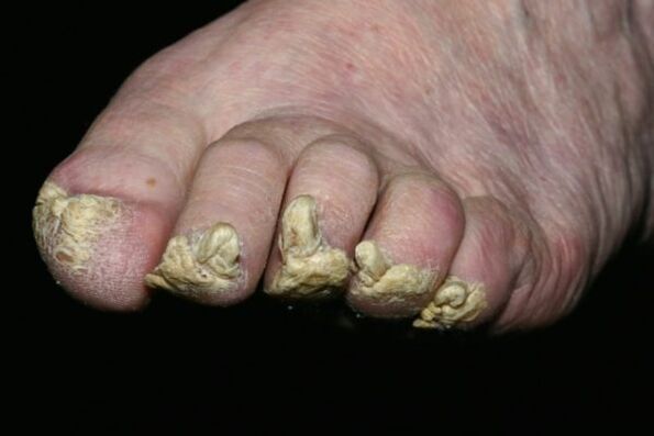 kojų nagų psoriazė