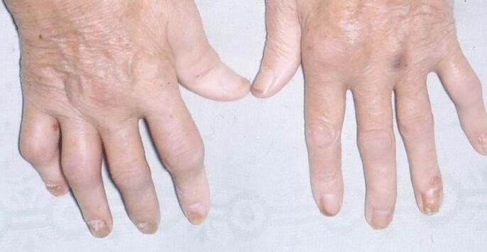 artropatinė psoriazė ant rankų