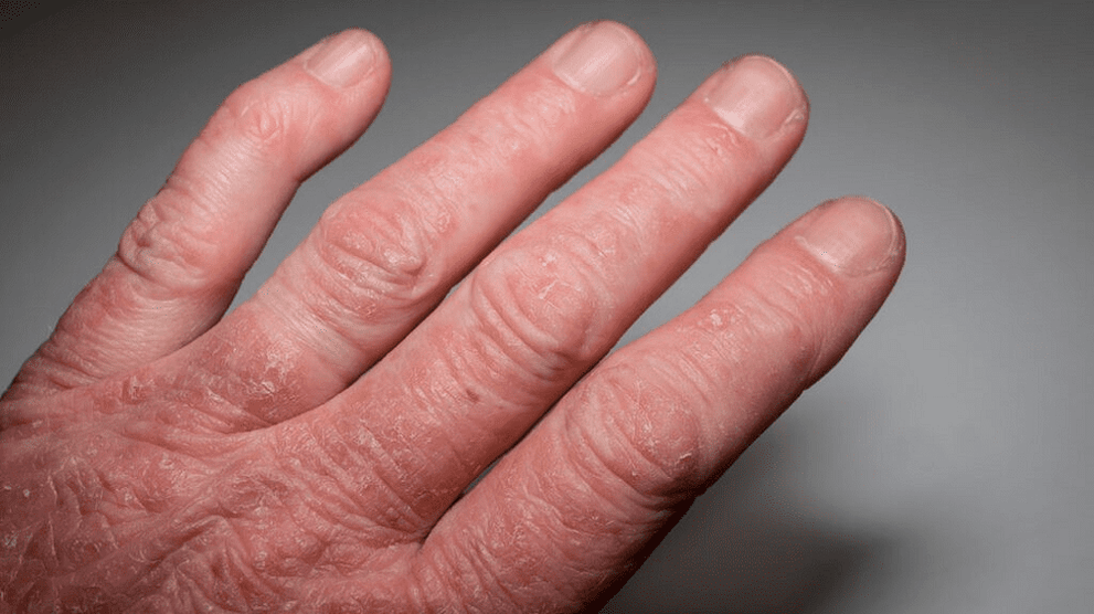 psoriazinis artritas ant rankų