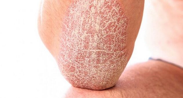 vulgaris psoriazė ant odos