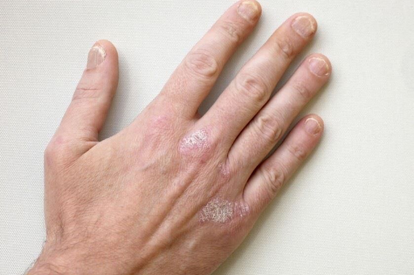 Privalomas psoriazės simptomas yra apnašos su apnašomis ant odos