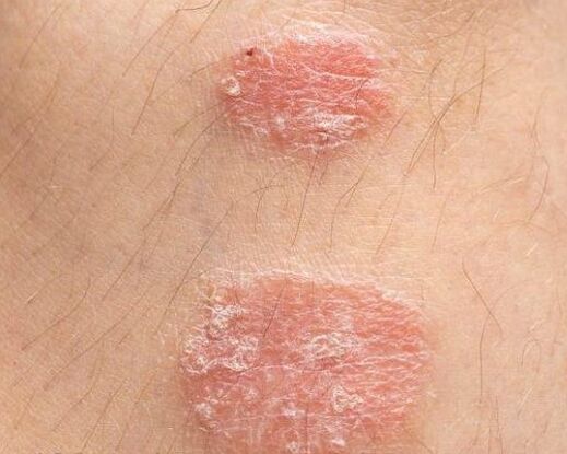 Psoriazinių plokštelių išvaizda
