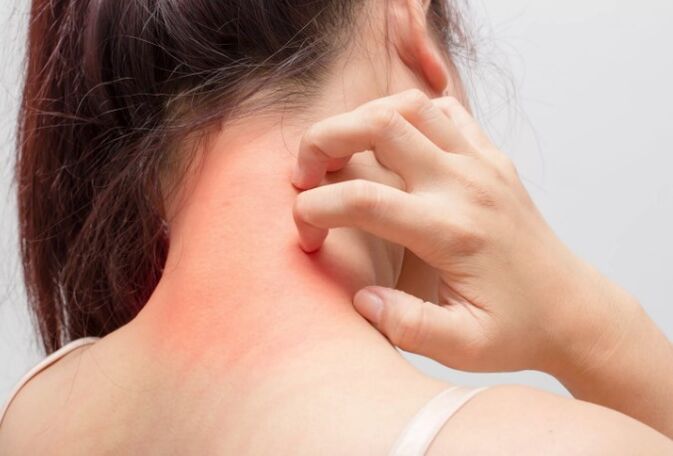 Niežėjimas yra viena iš psoriazės priežasčių
