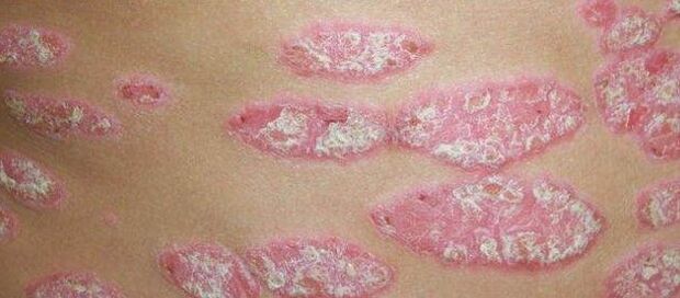 Progresyvus psoriazės etapas