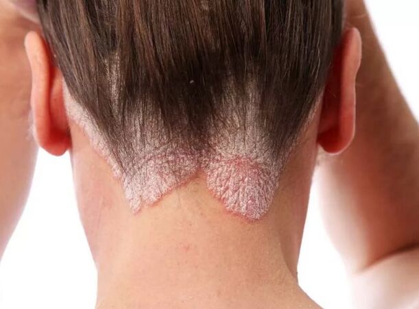 Psoriazinė eritroderma