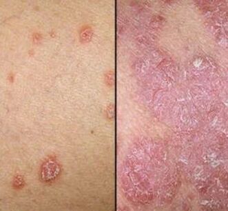 Psoriazinės plokštelės