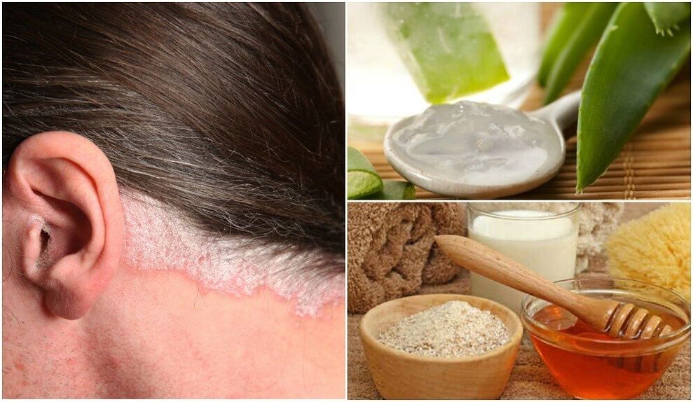 Psoriazės gydymas liaudies priemonėmis