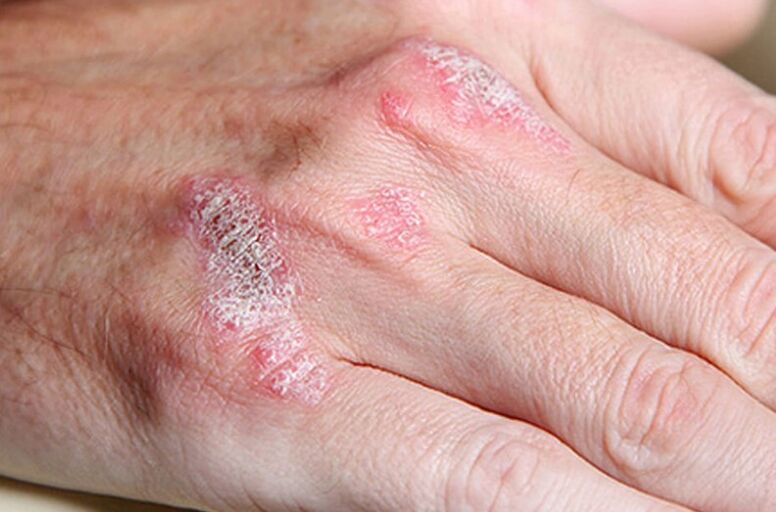 Ladomarizmo psoriazė