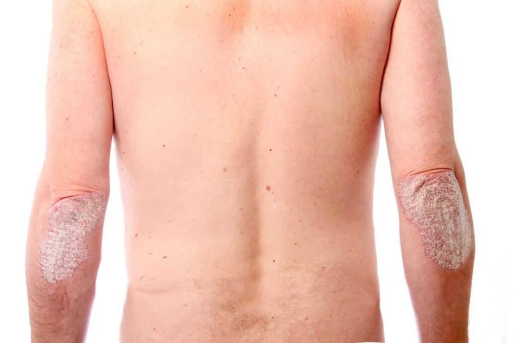 Antrasis psoriazės etapas