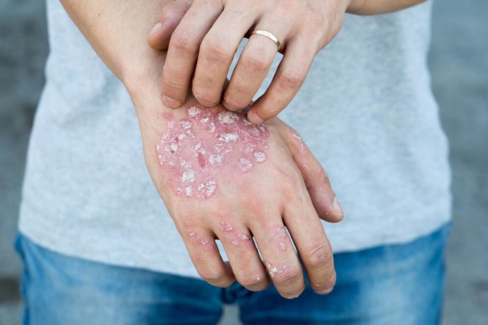Psoriazė yra