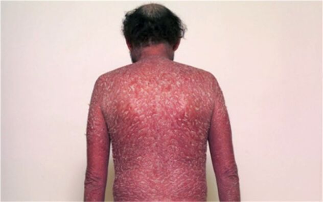 Trečiasis psoriazės etapas
