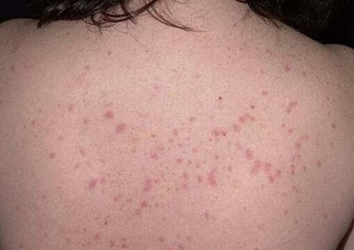 Pradinis psoriazės etapas