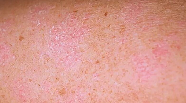 Regresyvus psoriazės etapas