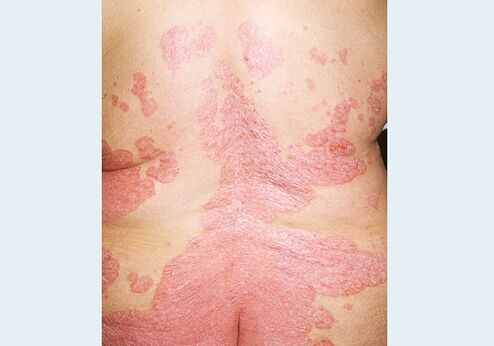 Nugaros psoriazė