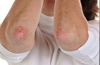 Psoriazė ant alkūnių