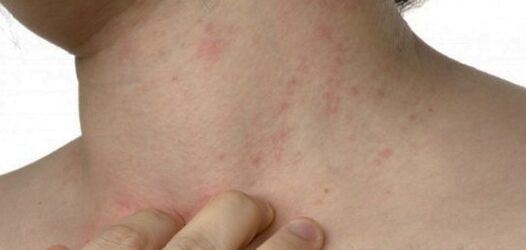 Psoriazė ant kaklo