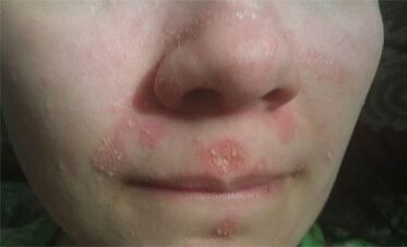 Psoriazė ant veido