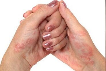Psoriazė rankose