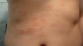 Psoriazė skrandyje