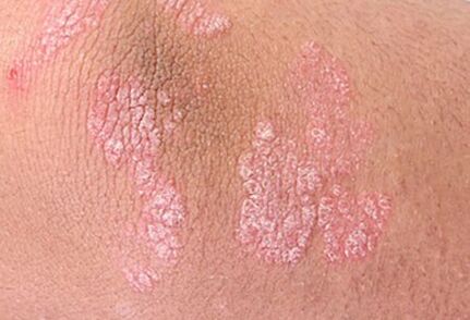 psoriazė