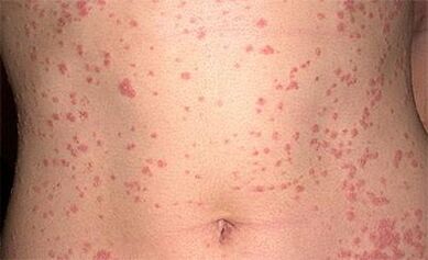 Psoriazė ant kūno