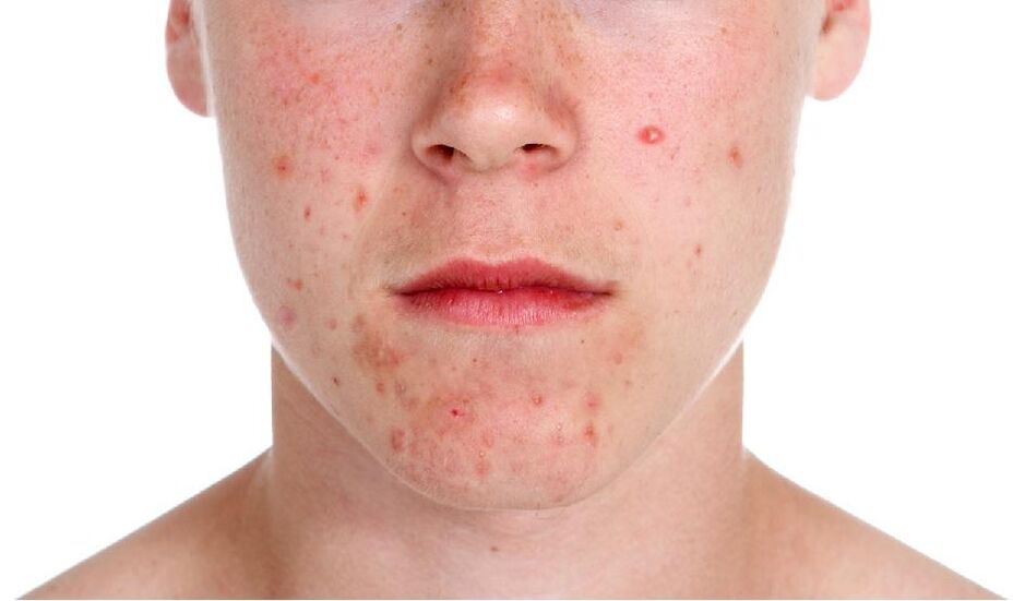 Psoriazė ant veido