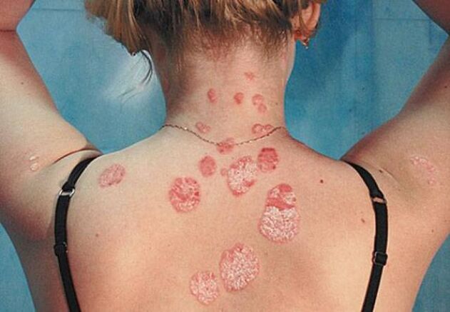 Psoriazė ant nugaros