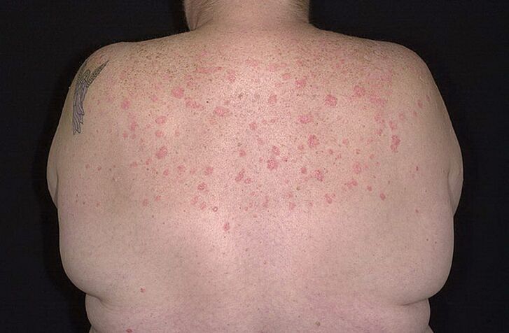 Psoriazė ant pečių