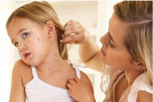 Pradinio psoriazės etapo nuotrauka