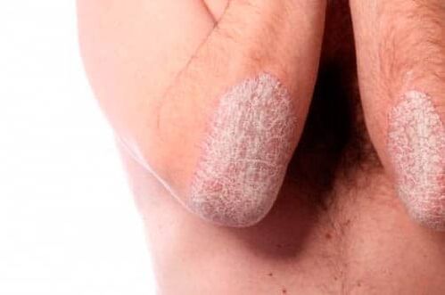 Psoriazė ant alkūnių