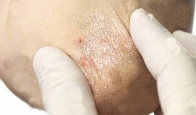 psoriazės gydymas silpnėjimo stadijoje