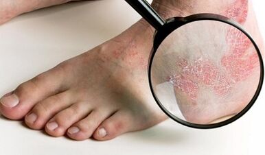 psoriazės gydymo galimybės