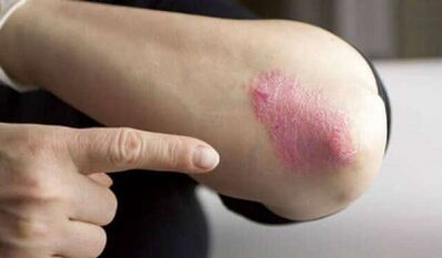 stacionari psoriazės vystymosi stadija