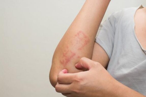 Naujausi psoriazės gydymo būdai