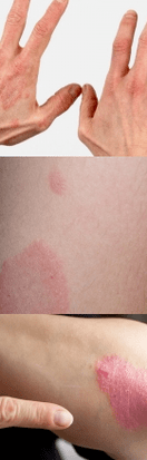 Pradinio etapo psoriazė ant rankų