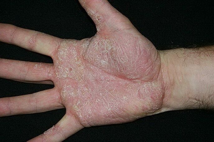 delnų ir pėdų psoriazė