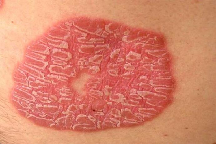 pustulinė psoriazė