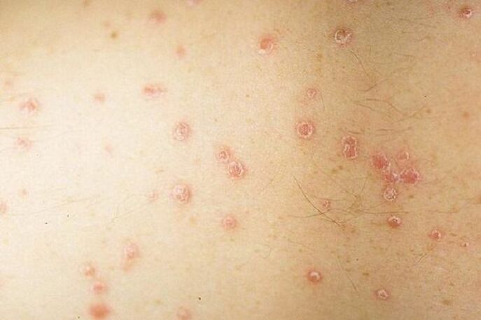 taškinės psoriazės simptomai