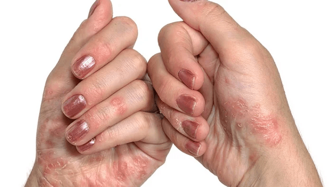 Pradinis psoriazės etapas