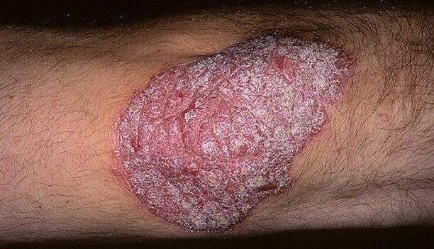 psoriazė