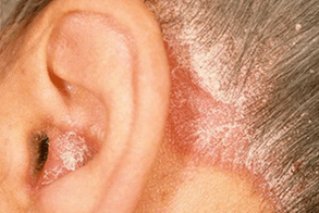 psoriazės priežastys