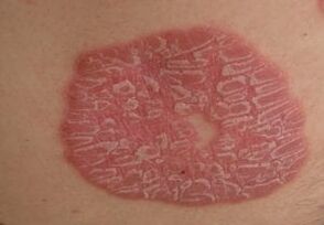 psoriazės nuotraukos ant odos