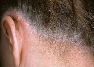 psoriazės priežastys ant galvos
