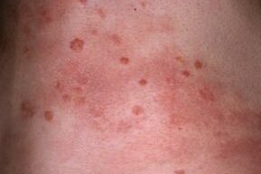 psoriazės nuotrauka ant odos
